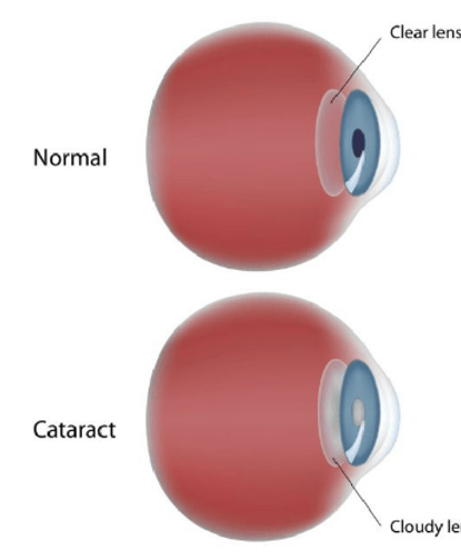 Cataract Treatment