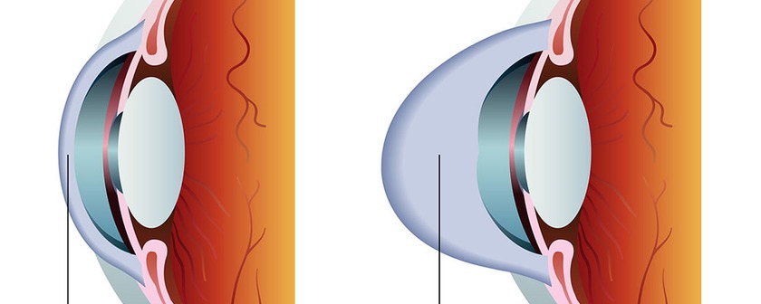 Cornea & Ocular Surface