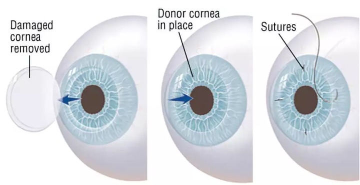 Corneal Transplant Surgeries