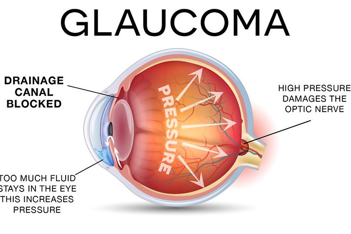 What is Glaucoma