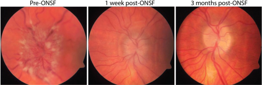 Optic Neuritis