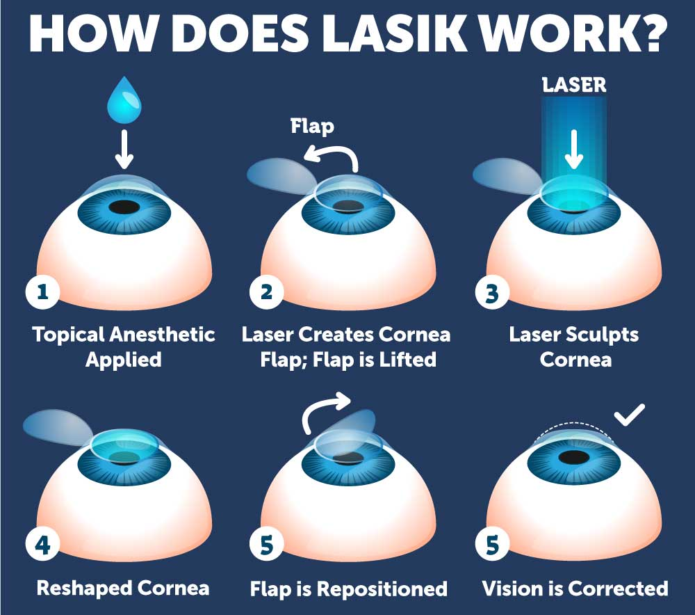 LASIK Procedure